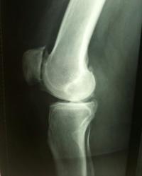 Chirurgie gonarthrose Douai Chirurgie gonarthrose Douai