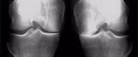 Opération arthrose genou Lille Opération arthrose genou Lille