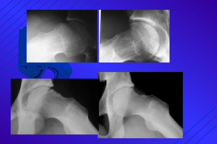 arthroscopie de hanche Lille arthroscopie de hanche Lille