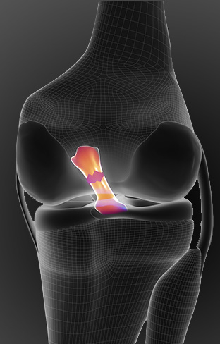 intervention du ligament